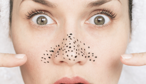 Средства от черных точек на носу: рейтинг 14 лучших косметических продуктов